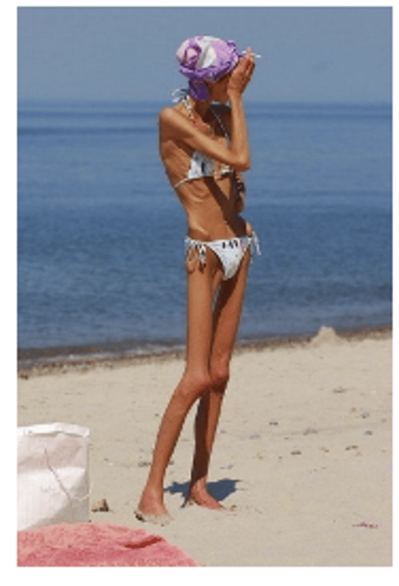 <p>Serious disturbance in eating with excessive concern over body shape and/or body weight</p><p>Examples: Anorexia nervosa, Bulimia nervosa, Binge-eating disorder</p>