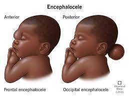 <p>Congenital neural tube defect where the sac containing the brain/ meninges/ cerebral fluid forms outside the skull due to bone defects. Can occasionally be caused by trauma or tumors. </p>