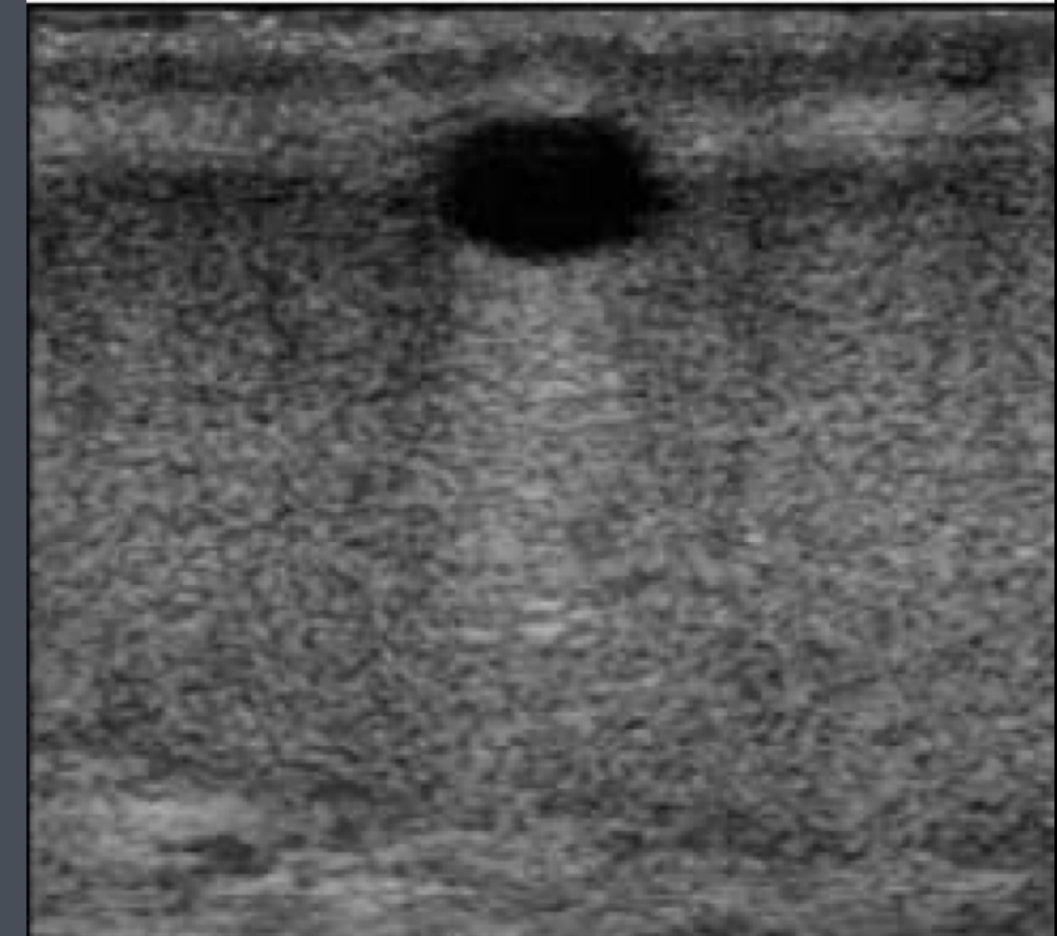 <p>What does the following describe?</p><p>• are uncommon</p><p>• these cysts are believed to be mesothelial in origin</p><p>•Clinically, may present as a pain- less scrotal lump.</p><p>• are generally seen in men ages 50-60</p>