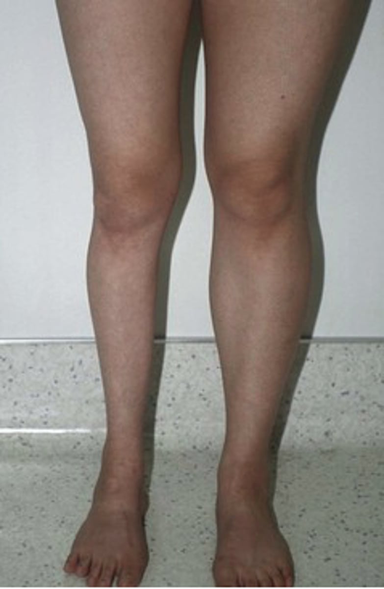 <p>atrophy</p>