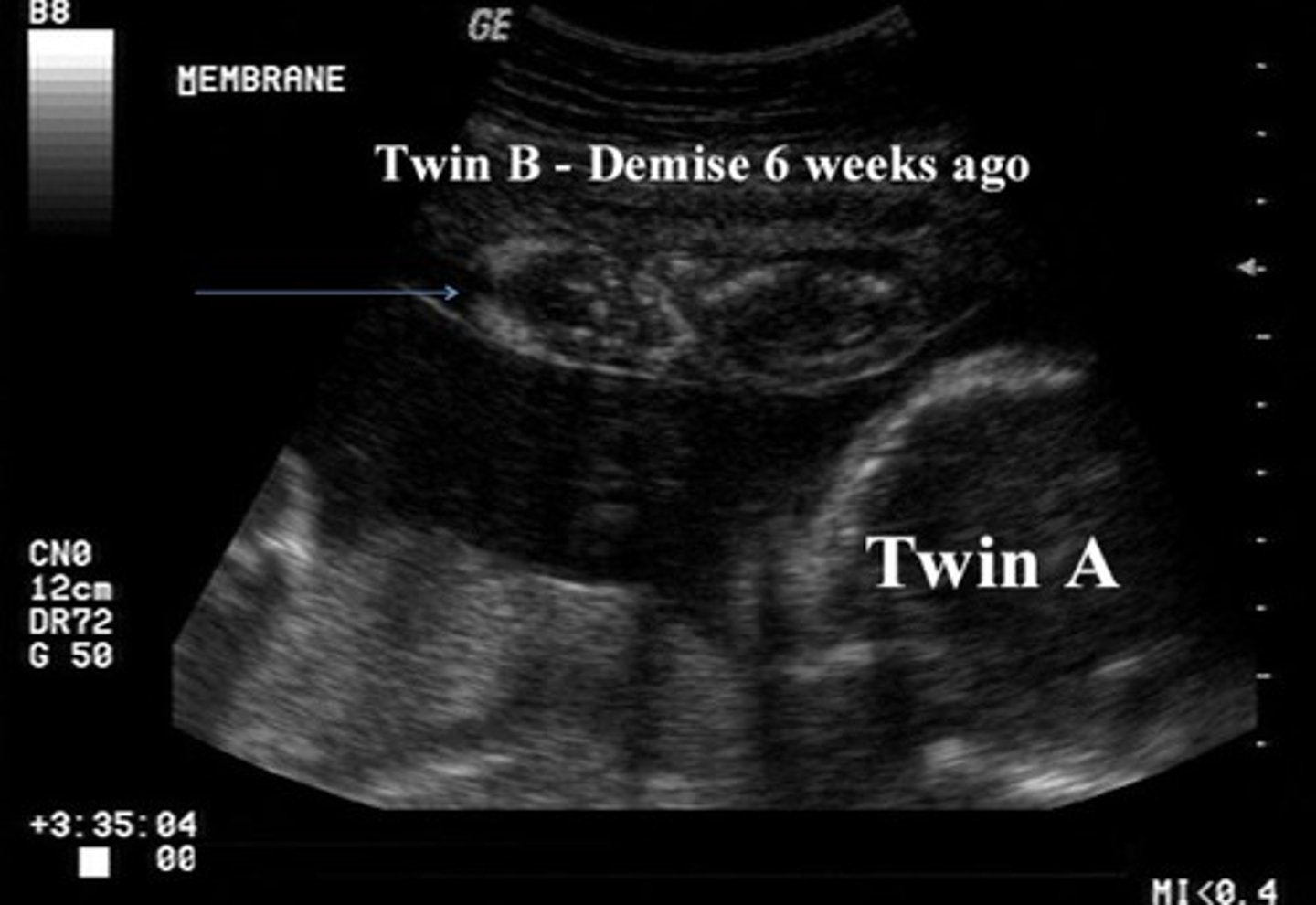 <p>Fetal demise too large to be reabsorbed</p><p>Fetus appears flattened due to oligohydramnios</p>