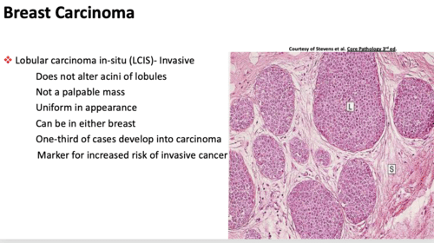 <p>lobular carcinoma in-situ (LCIS)</p>