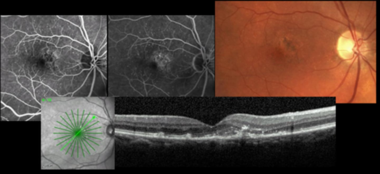 <p>What can cause a CNV?</p>