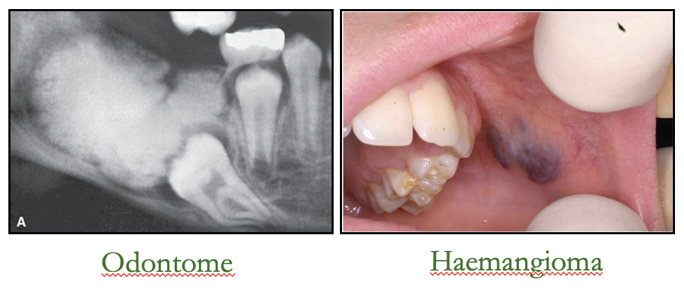 <p>what are examples of hamartomas</p>