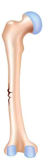 <p>Bone breaks incompletely, only one side of the shaft breaks while the other bends.</p><ul><li><p>common in children</p></li></ul><p></p>