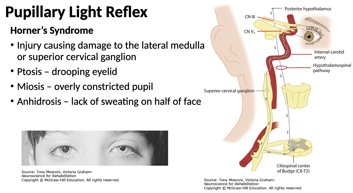 <p>what is Horoner’s Syndrome?</p>