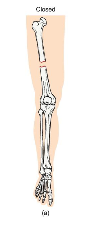<p><strong>Definition</strong>: Bone breaks but <strong>does not penetrate the skin</strong></p><p><strong>Mechanism: Usually caused by a direct blow or bending stress</strong></p><p><strong>Clinical note: Lower infection risk;</strong> easier to manage if aligned</p><p><strong>Key Concept</strong>: Skin remains intact → internal healing environment protected</p>