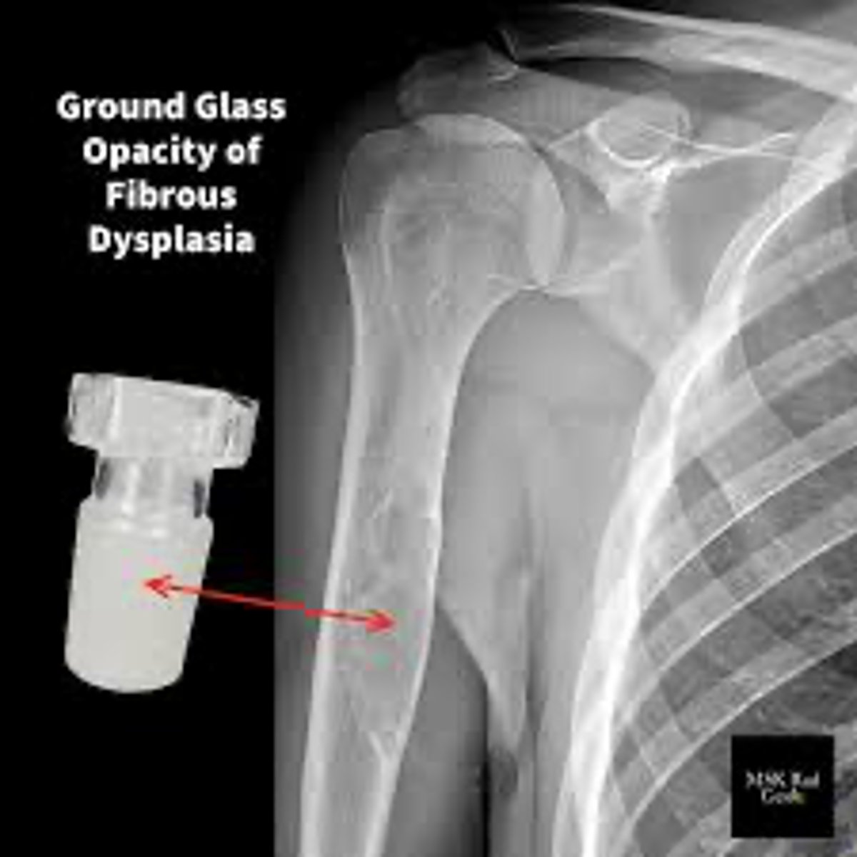 <p>Ground glass opacity</p>