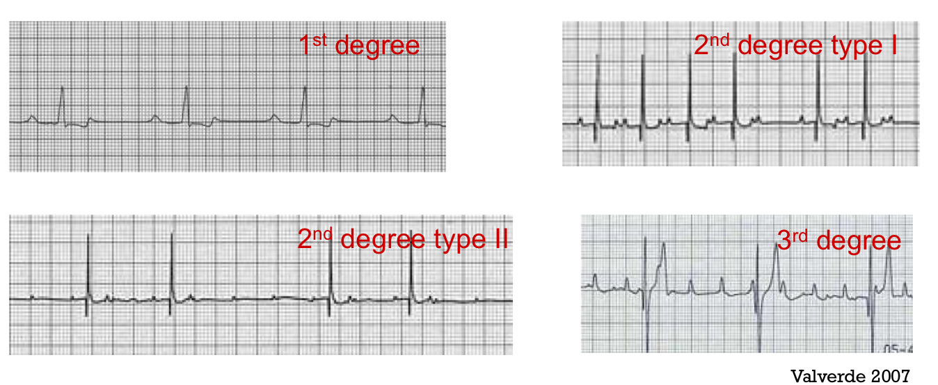 <p>Conduction from atria to ventricles is not working </p><ul><li><p>slow conduction → 1st degree AV black </p></li><li><p>P waves not followed by QRS complex (2nd &amp; 3rd degree)</p></li><li><p>Bradycardia is common </p></li><li><p>Due to inc vagal tone</p></li><li><p>Drug induced → alpha 2, anticholinergics </p></li><li><p>Intrinsic cardiac disease  </p></li></ul><p></p>