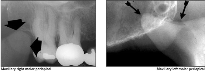 <p>Coronoid process</p><ul><li><p>a prominence of bone on the anterior ramus of the mandible </p></li><li><p><u>Radiography: appears as</u><strong><u> triangular radiopacity</u></strong><u> with its apex divided &amp; in the region of the third molar.</u></p></li><li><p><span><em>**The coronoid process is the only mandibular structure recorded on maxillary molar periapicals.</em></span></p></li></ul><p></p>