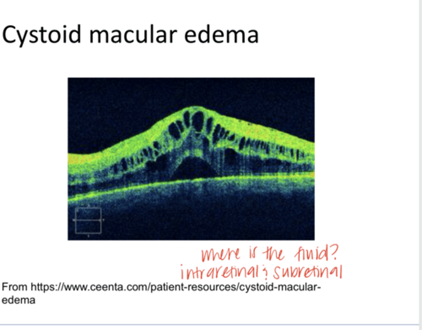 <p>Cystoid Macular Edema on OCT (Pic)</p>