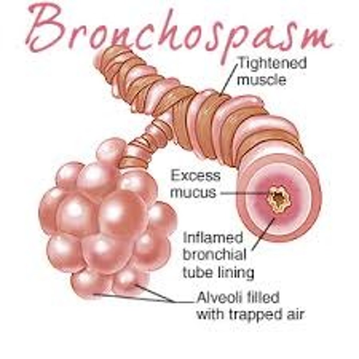 <p>definition: contraction of bronchi smooth muscles, restricting airflow</p><p>signs: wheezing, labored breathing</p><p>treatment: 100% O2, albuterol, Ipratropium, epinephrine, intubation</p>