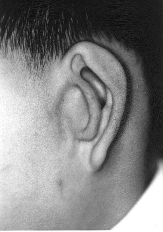 <p>When parts of auricle are duplicated, sometimes leading person to develop a second tragus- may occur in hemifacial microsomia. </p>