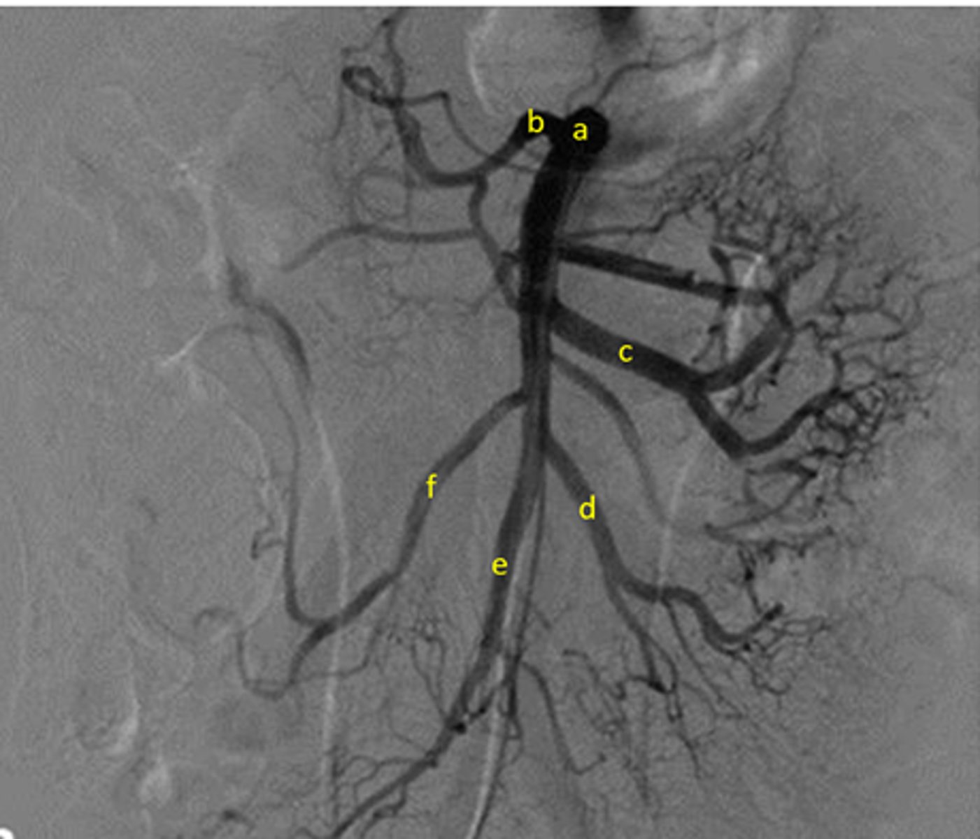 <p>A: SMA</p><p>B: Middle Colic</p><p>C:Jejunal arteries</p><p>D: Ileal arteries</p><p>E: Iliocolic</p><p>F: Right colic</p>