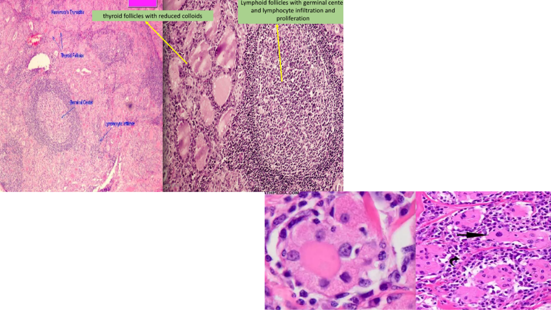 <p>Hashimoto’s Thyroiditis</p>