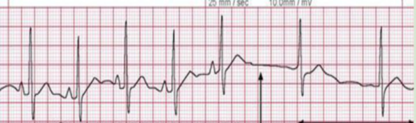 <p>Failure of the sinus node → brief pause → takeover of rhythm by the AV node</p><p>-inversion or absence of P wave will present in new rhythm</p>