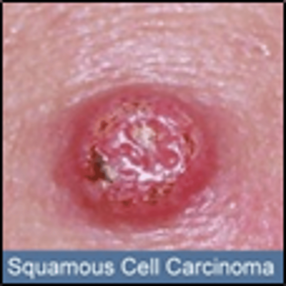 <p>elevated growth with central ulcer or red scaly patch</p><p>• fair skin - sun exposure</p><p>• common location: face</p>