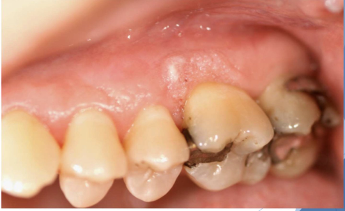 <p>Patient negative for HPV. What do you suspect?</p>