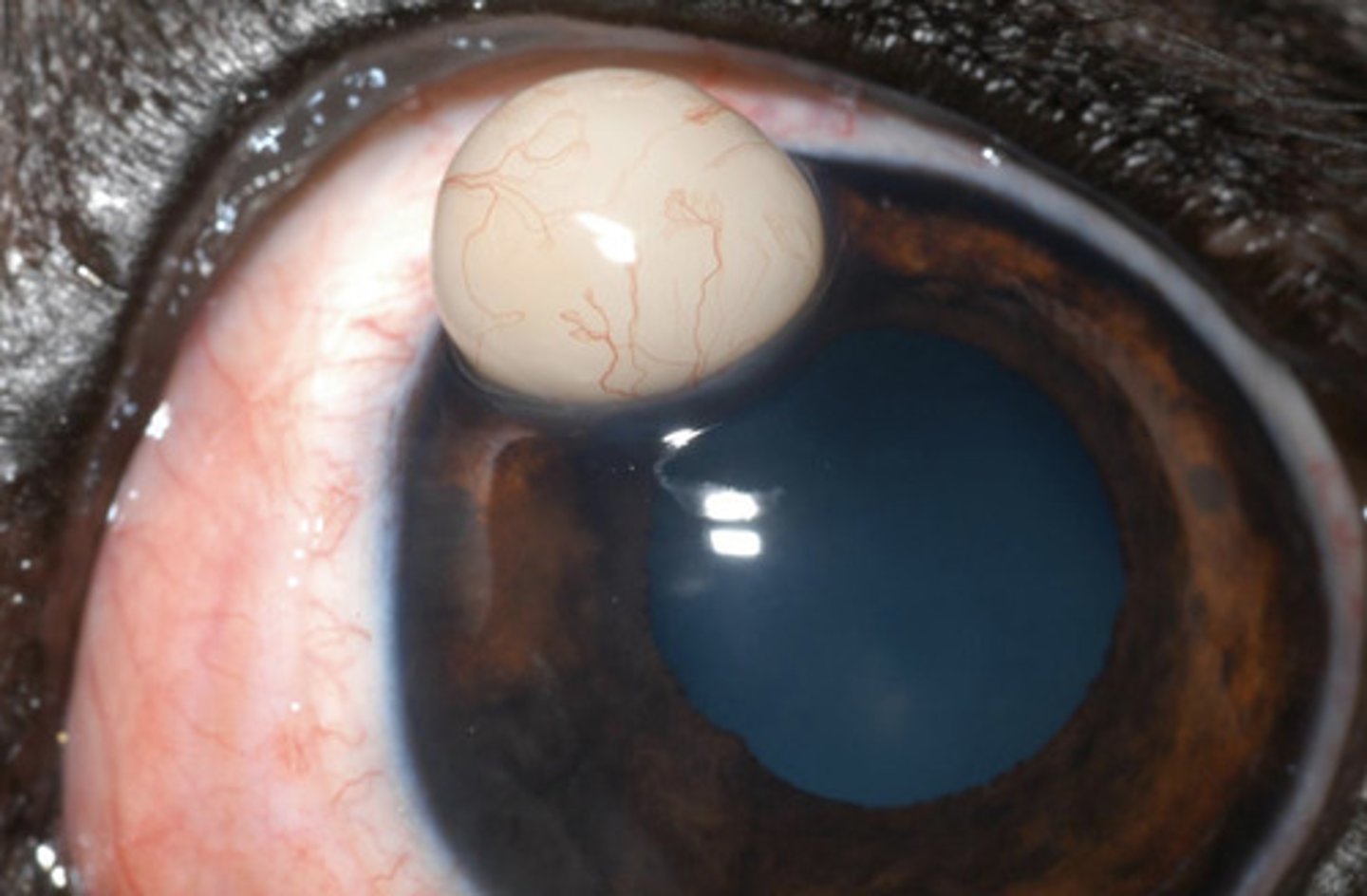 <p>What am I describing?</p><p>- White opacities</p><p>- Benign entrapment of epithelium within the stroma</p><p>- Non-painful, no problems</p>