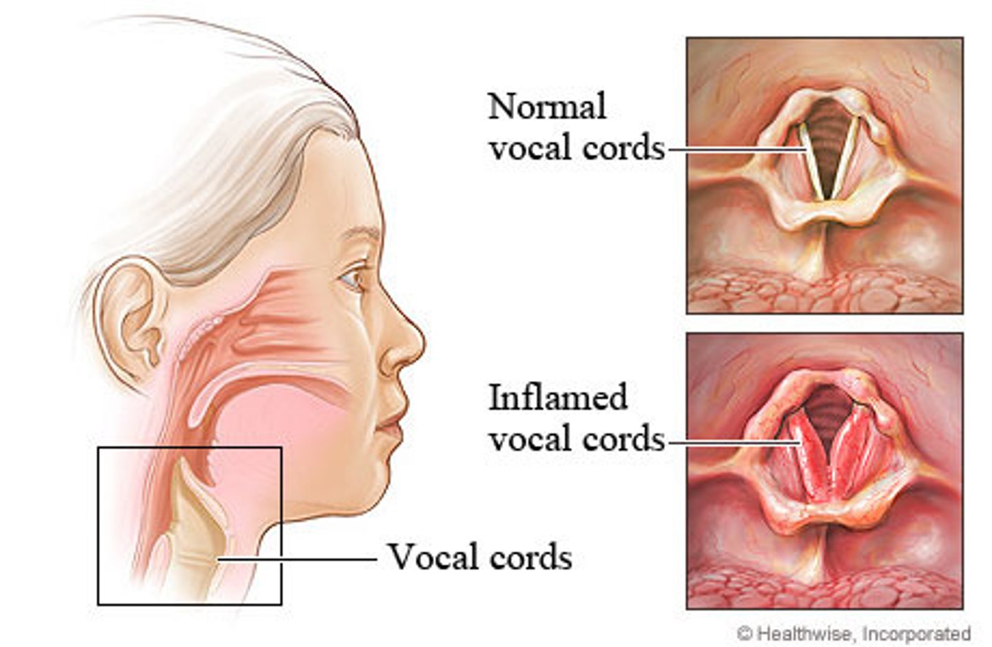 <p>inflammation of the larynx</p><p></p><p>causes:</p><p>- infection</p><p><strong>- overuse (lost voice)</strong></p>