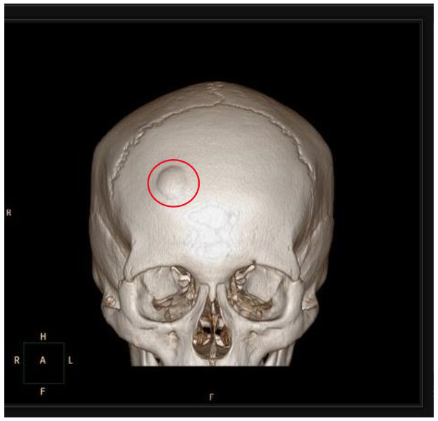 <p><strong><span style="color: red">bosselated, round sessile tumors</span> that project from the <span style="color: red">subperiosteal or endosteal surface of cortex</span></strong></p><ul><li><p><strong><mark data-color="blue">composed of woven &amp; lamellar bone</mark></strong></p></li><li><p>slow growing</p></li></ul><p>clinical presentation</p><ul><li><p>solitary &amp; <strong><mark data-color="green">detected in middle age</mark></strong></p></li></ul><p>related/associated disease</p><ul><li><p><strong>Gardner syndrome</strong></p></li></ul>