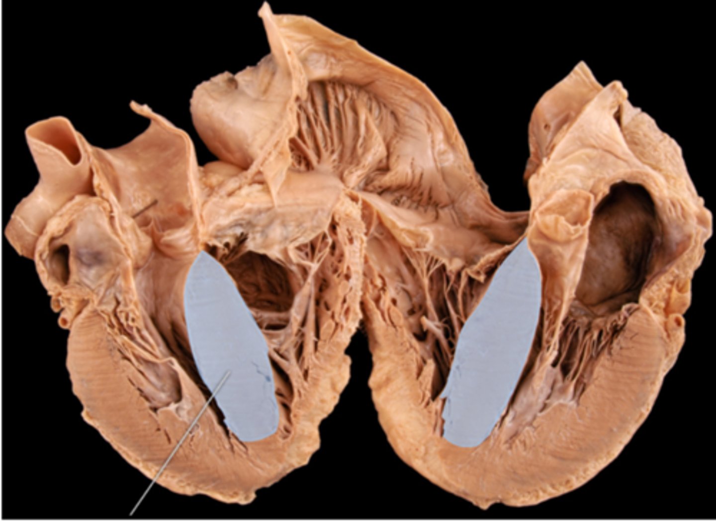<p>interventricular septum</p>