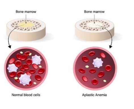 <p>aplastic anemia - bone marrow stem cells present but fail to produce sufficient blood cells</p>