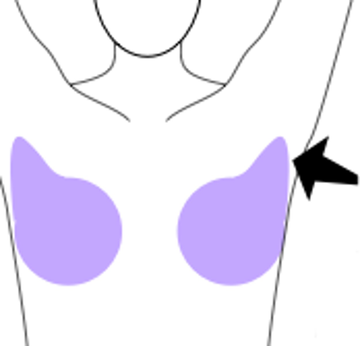<p>extension of breast tissue into the axilla</p>