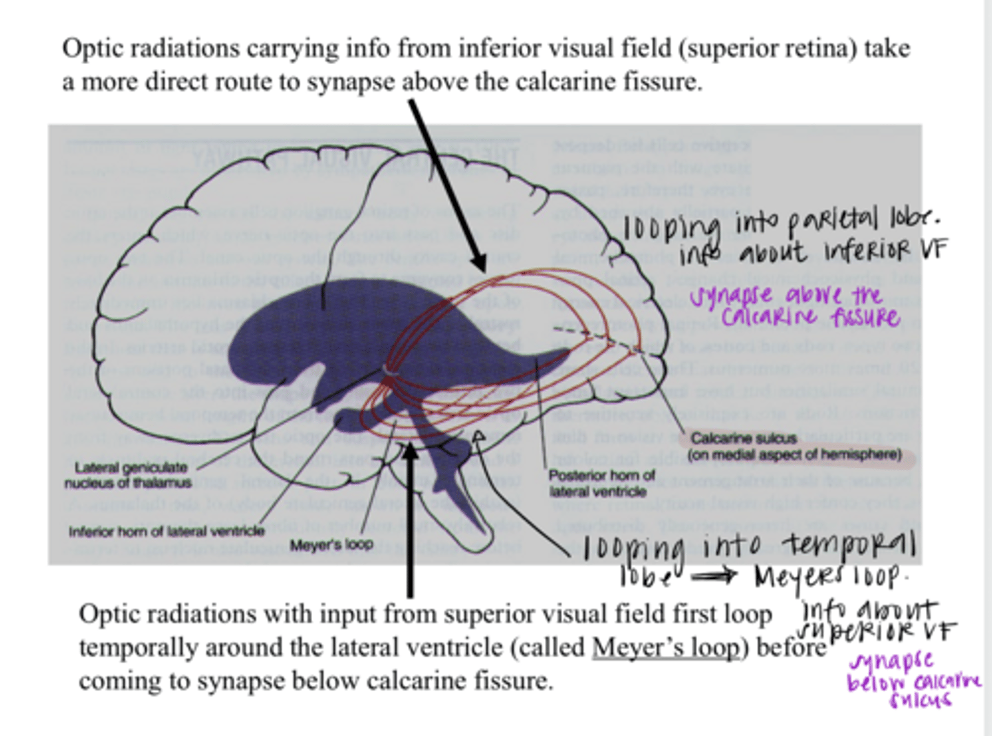 <p>Optic radiations carrying info from the superior VF (falls on the inferior retina) will loop through which lobe on their way to the occipital lobe?</p>
