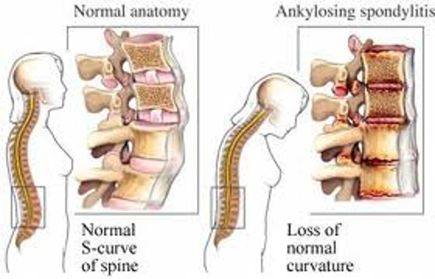 <p>may be seen with a herniated lumbar disc or ankylosing spondylitis</p>