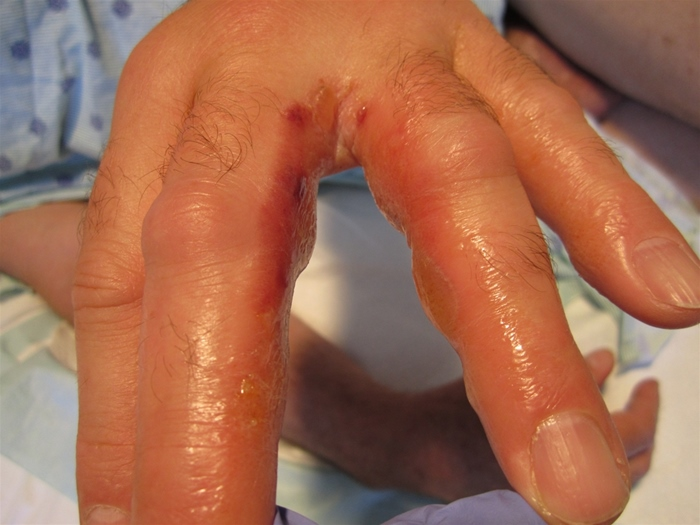 <p>person with 2 day pruritic rash after clearing bushes around house. Diagnosis and cause?</p>