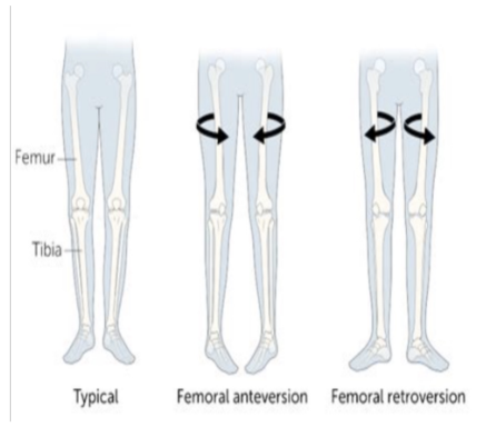 <p>● Hip internal rotation</p><p>● Tibial internal torsion</p><p>● Subtalar pronation</p><p>● Toe in</p><p>● Squinting patellae</p>