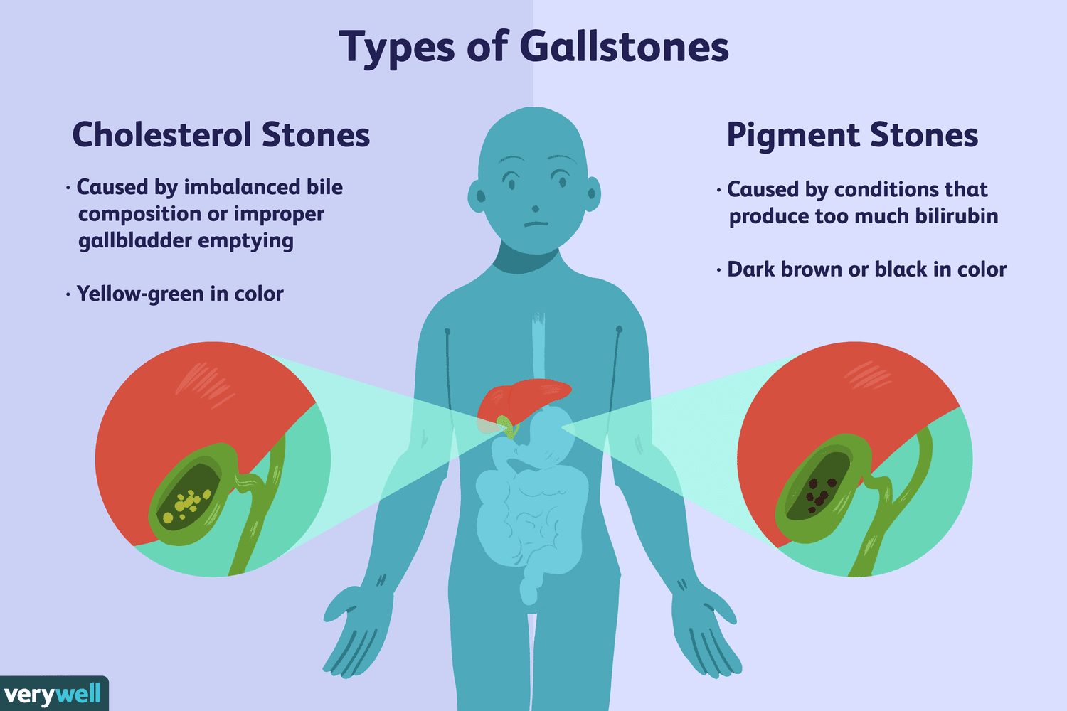 <p></p><ul><li><p>Hardened deposits of digestive fluid; hard, pebble-like pieces of material, usually made of cholesterol or bilirubin, that form in the gallbladder</p></li><li><p>Gallstones can range in size from a grain of sand to a golf ball. The gallbladder can make one large gallstone, hundreds of tiny stones, or both small and large stones.</p></li><li><p>Symptoms include steady, severe pain in the upper abdomen that increases rapidly and may last from 30 minutes to several hours, pain in the back between the shoulder blades, pain in right shoulder, fever, nausea, vomiting, chills, jaundice</p></li></ul>