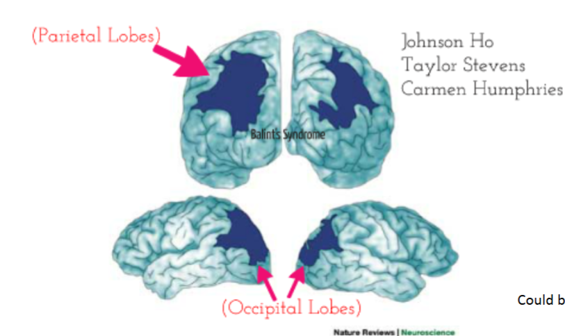 <p>caused by bilateral damage to regions of posterior parietal(sensory association areas taht allow us to detect where things are in space) and occipital cortex; could be caused by stroke, dementia</p>