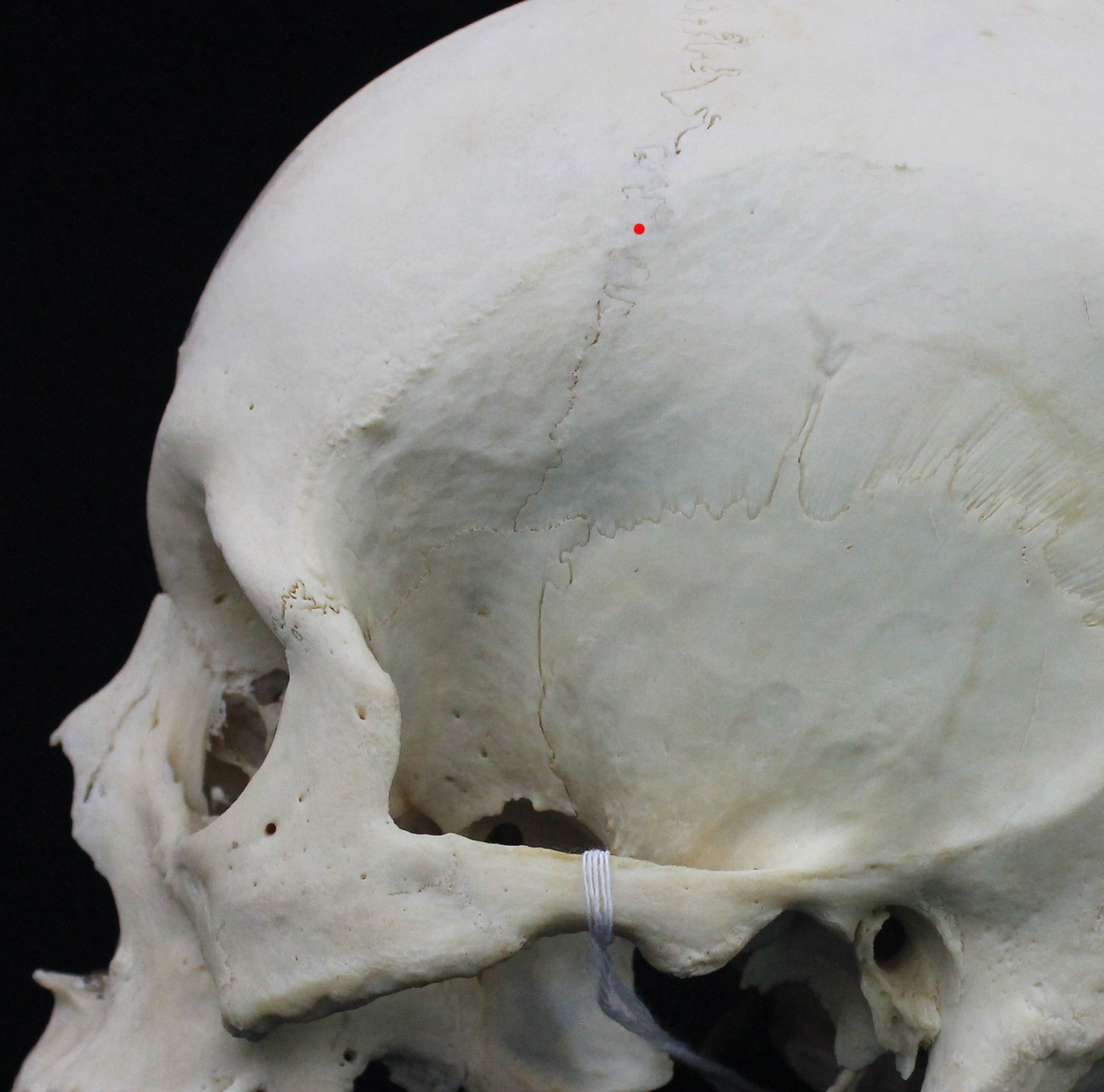 <p>Point where coronal suture crosses temporal line</p>