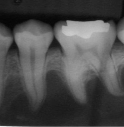 <p>radiolucent lesion that extends between the roots, seen in traumatic bone cyst (TBC) </p>