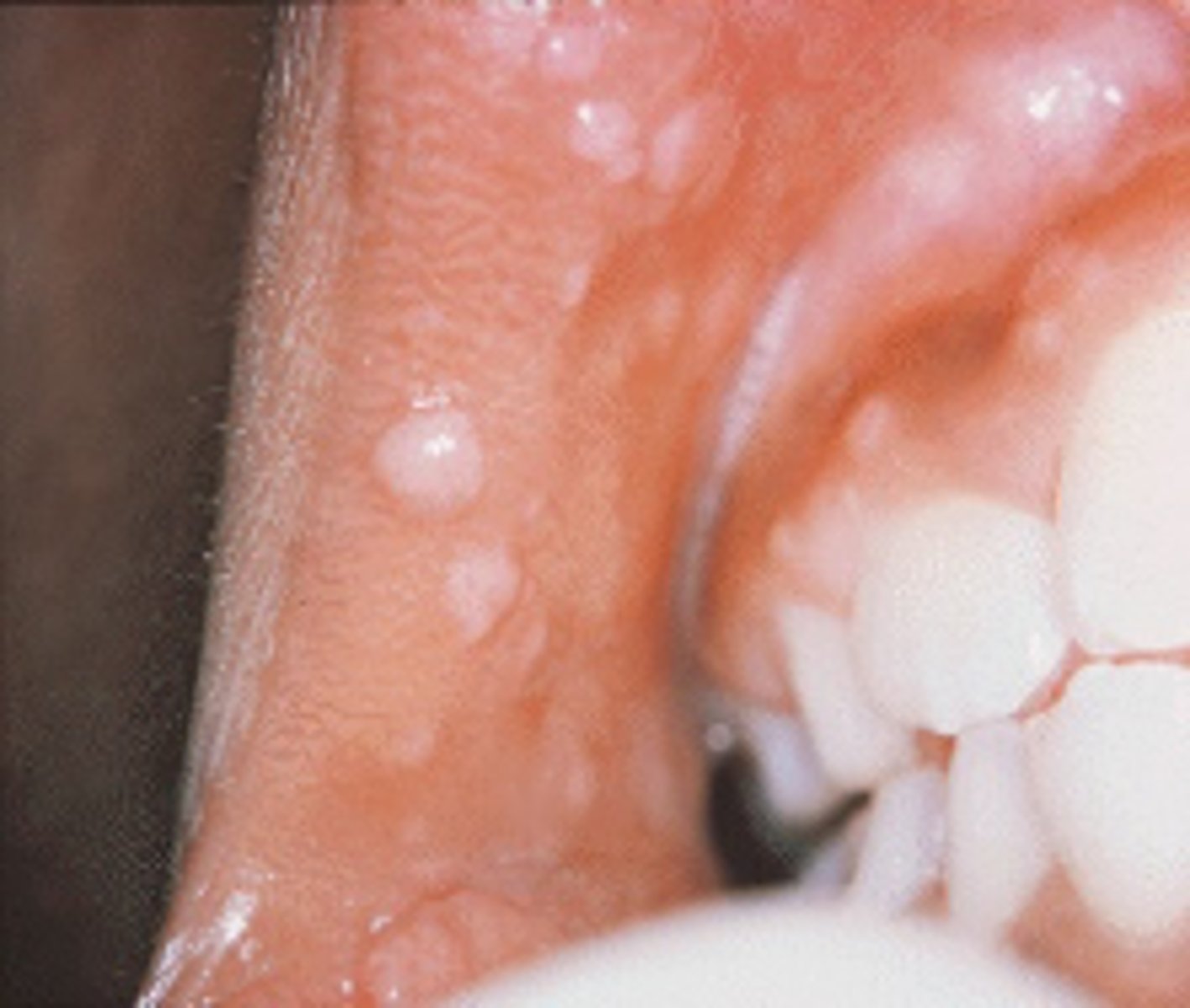 <p>Heck Disease</p>