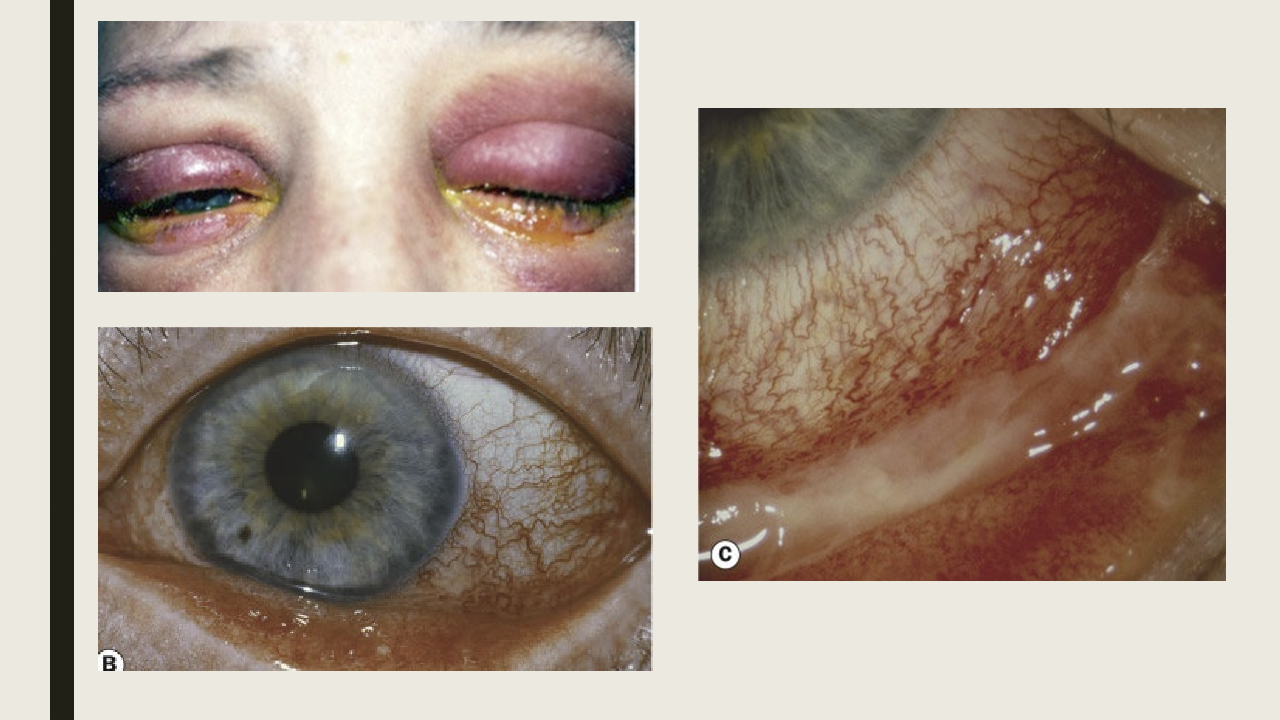 <ul><li><p>Symptoms: redness, grittiness, burning, and discharge</p></li><li><p>Presentation: Unilateral and becomes bilateral within 1-2 days. Lid edema and redness, Conj hyperemia, mucuopurulent discharge, PEE, no lymphadenopathy.</p></li></ul><p></p>