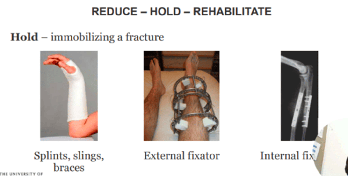<p>1) Reduce</p><p>Restore anatomical alignment of fracture/dislocation</p><p>2) Hold</p><p>Immobilisation of fracture e.g., splints, slings, braches, internal/external fixation</p><p>3) Rehabilitate </p><p>Intensive physiotherapy</p>
