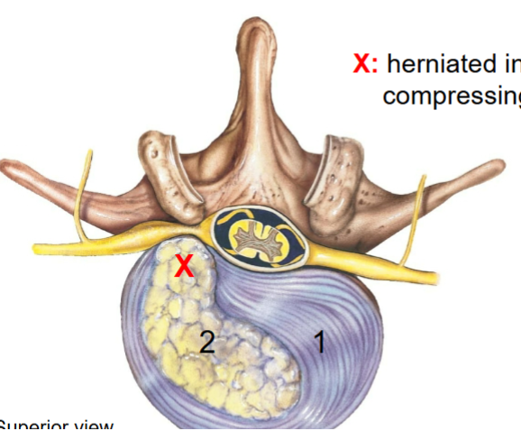 <p>Cartilage portion of the body in vertebra (1)</p>