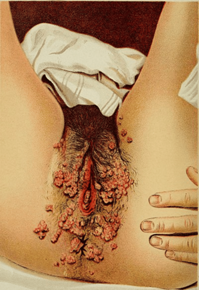 <p>Warts form around cervix, vulva, urethra, glans penis, and anus and anal canal</p><p>ÒMajority caused by Viruses HPV-6 and HPV-11</p><p>crotherapy</p>