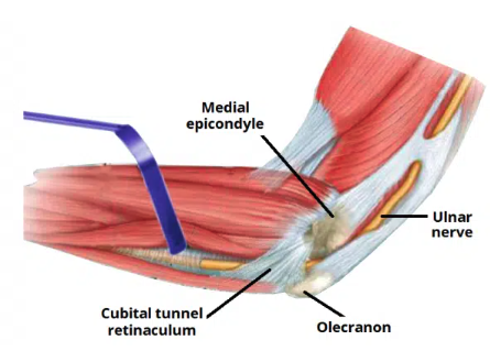 <ul><li><p>Medial: medial epicondyle of the humerus</p></li><li><p>Lateral: olecranon of the ulna</p></li><li><p>Floor: elbow joint capsule and medial collateral ligament of the elbow</p></li><li><p>Roof: ligament spanning between the medial epicondyle and olecran</p></li></ul><p></p>