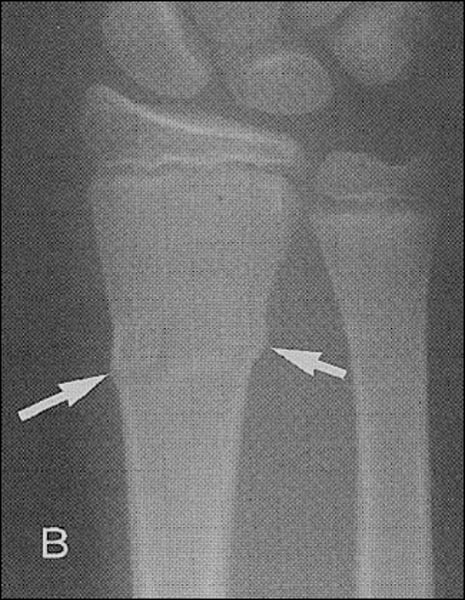 <p>impacted fracture with bulging of periosteum</p><p>(More often seen in peds.)</p>