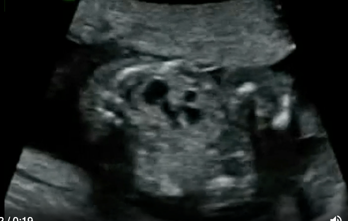 <p>a) duodenal atresia</p><p>b) posterior urethral valves</p><p>c) unilateral multicystic dysplastic kidney</p><p>d) autosomal recessive polycystic kidney disease</p>