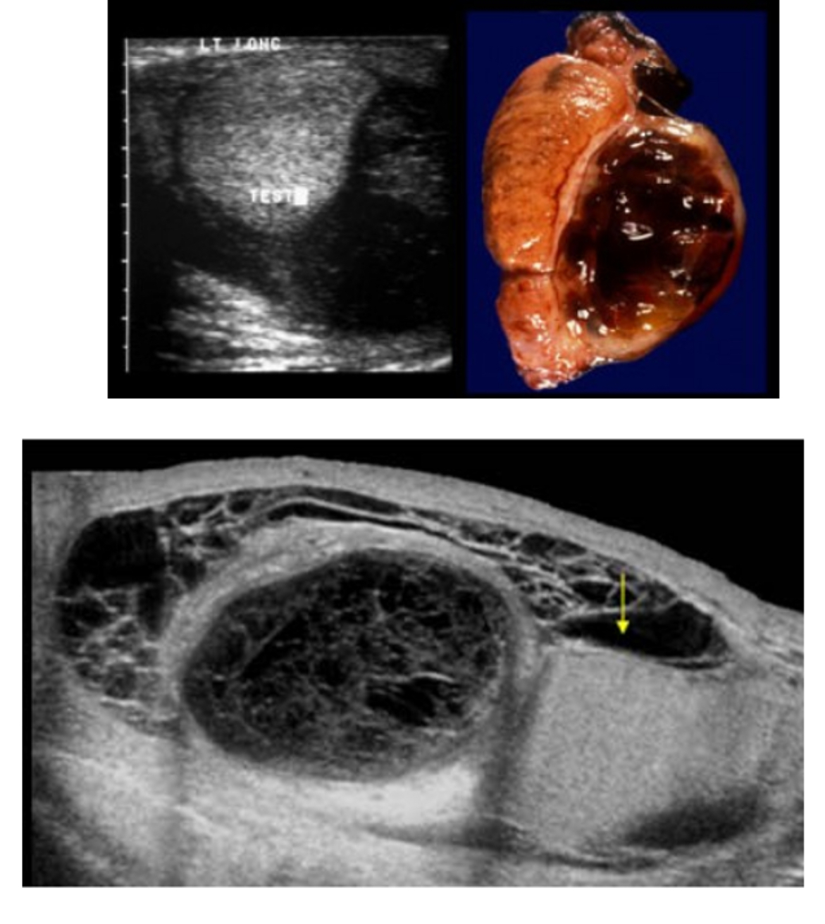 <p>What does the following describe?</p><ul><li><p><span>results from scrotal or intra-abdominal hemorrhage.</span></p></li><li><p><span>﻿﻿It represents bleeding between the layers of the tunica vaginalis and appears as complex fluid collection</span></p></li><li><p><span>﻿﻿With time, this collection can develop loculations, which appear as thick septations.</span></p></li><li><p><span>﻿﻿blood fills scrotal chamber; can be associated with trauma, surgery, torsion or neoplasms</span></p></li></ul>