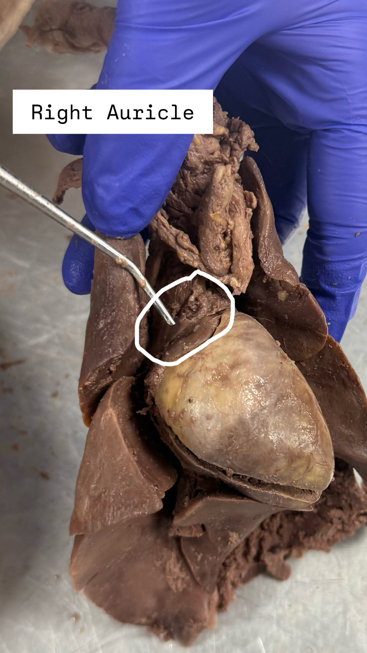 <p>Right Auricle (<span><span>"AW-ri-kuhl)</span></span></p>