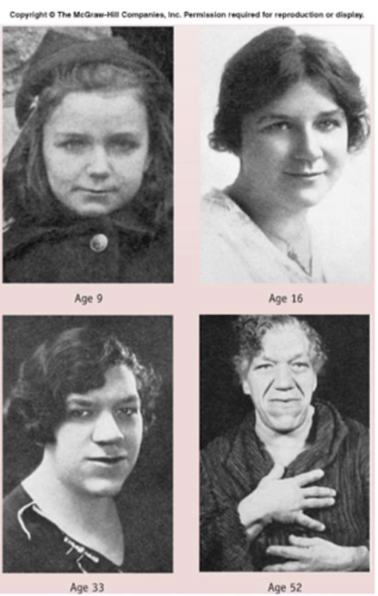 <p>excess GH secretion in adults that is often associated with an adenoma. bones will become broader and heavier, soft tissue will grow causing enlarged hands and feet, along with changes in facial features.</p>
