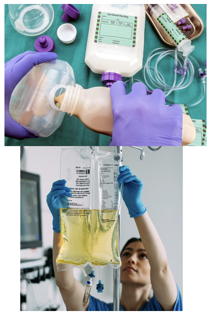 <p><strong>Catabolic process body breaks down lean muscle, so nutritional support is key.</strong></p><ul><li><p>Enteral nutrition (via the GI tract) is preferred, but parenteral nutrition (via central line) can be given if the patient has GI impairment.</p><ul><li><p><strong>Caloric intake may start off slowly </strong>due to fragile state of body (~12.5 kCal/kg), but as the body recovers, <strong>caloric intake is slowly increase</strong>d to ~20-25 kCal/kg.</p><ul><li><p>low → up</p></li></ul></li><li><p>Protein intake is important—Shock patients should receive roughly 1.3 g/kg/day rather than the usual recommendation of 0.8 g/kg/day.</p><ul><li><p>up → down</p></li></ul></li><li><p>Nutrition includes carbohydrate (dextrose), amino acids, lipids, electrolytes, vitamins, trace elements (zinc, copper, manganese, selenium, etc.), and water. ← (TPN)</p></li></ul></li><li><p>Administration of protective meds (antacids, H2 blockers, PPIs) are also important to prevent peptic ulcer formation.</p></li></ul><p></p>