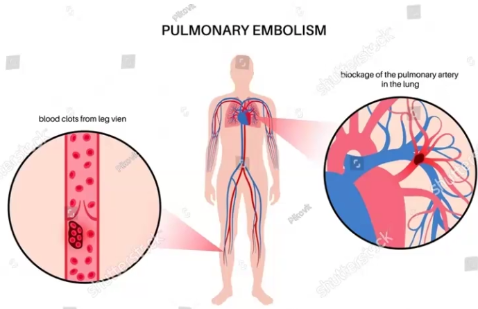 <ul><li><p>Defined by thrombi that occludes the large pulmonary arteries</p></li><li><p>Causes pulmonary hypertension and ischemia of downstream pulmonary parenchyma</p></li><li><p>Most embolisms are clinically silent</p><ul><li><p><strong>Some are non-thrombotic</strong>, that means the blockage is not caused by blood, but by other things such as amniotic fluid, fat/marrow, foreign bodies and air</p></li><li><p>May result in right heart failure or shock/death</p><p></p></li></ul></li></ul><p></p>