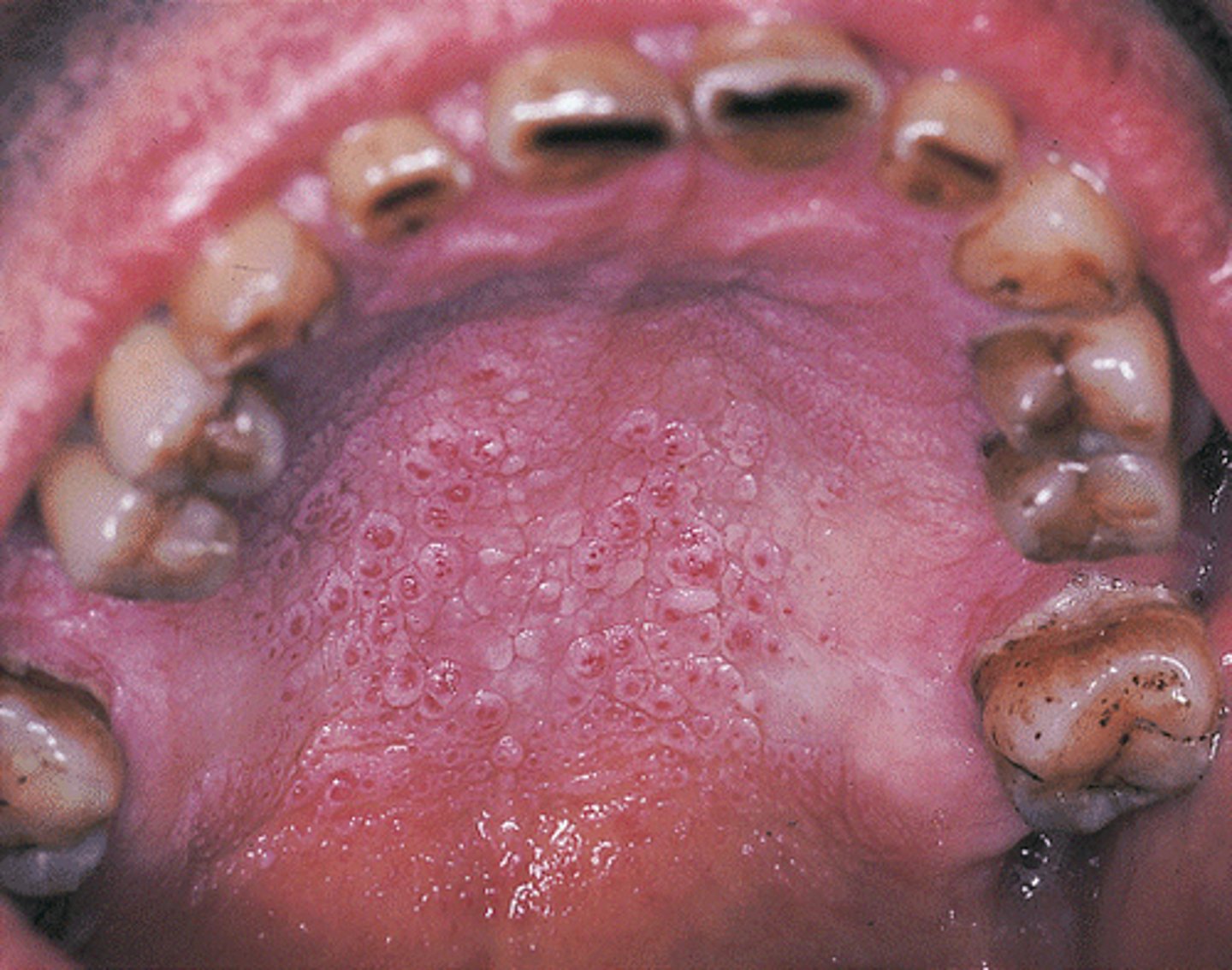 <p>Nicotine stomatitis</p>